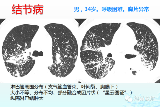 肺粟粒样结节鉴别诊断
