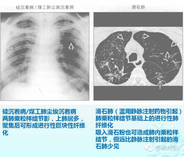 肺粟粒样结节鉴别诊断