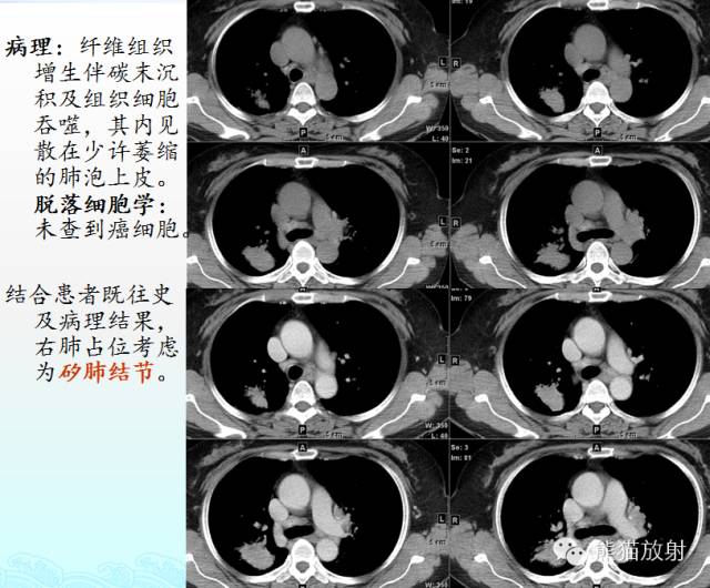 肺粟粒样结节鉴别诊断
