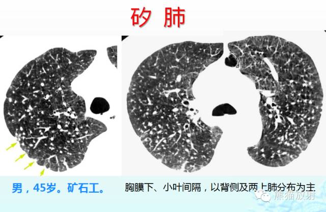 肺粟粒样结节鉴别诊断
