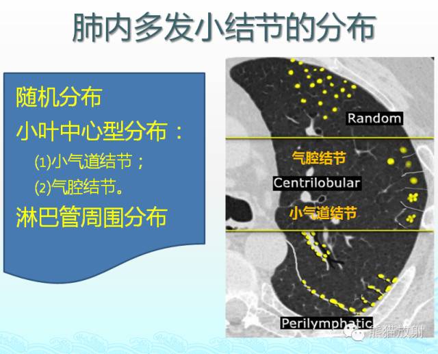 肺粟粒样结节鉴别诊断
