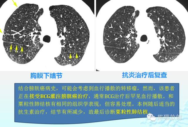 肺粟粒样结节鉴别诊断