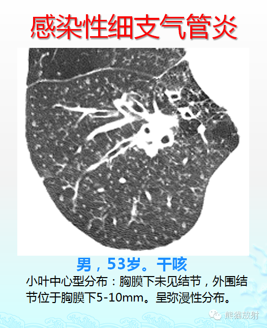 肺粟粒样结节鉴别诊断