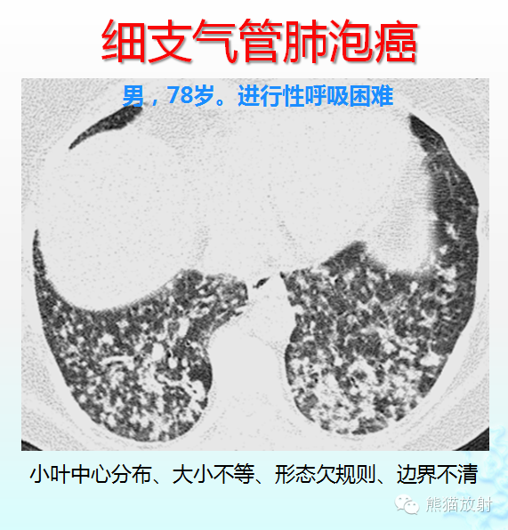 肺粟粒样结节鉴别诊断