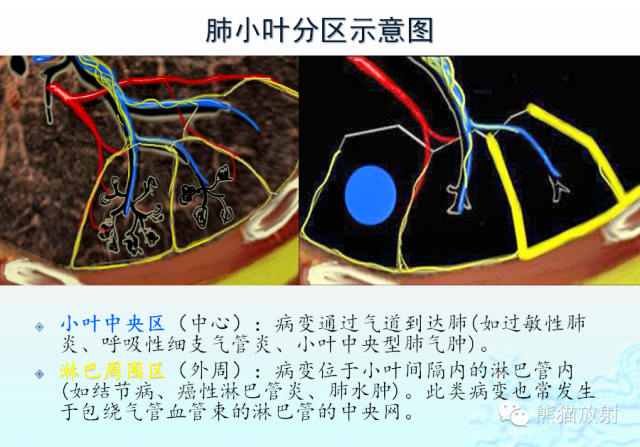 肺粟粒样结节鉴别诊断