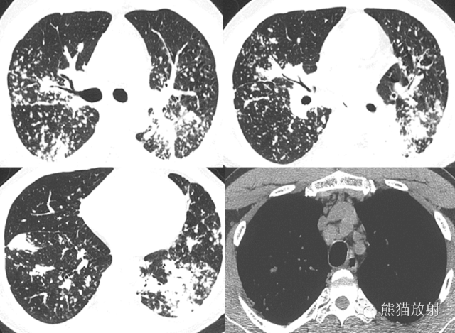 肺粟粒样结节鉴别诊断