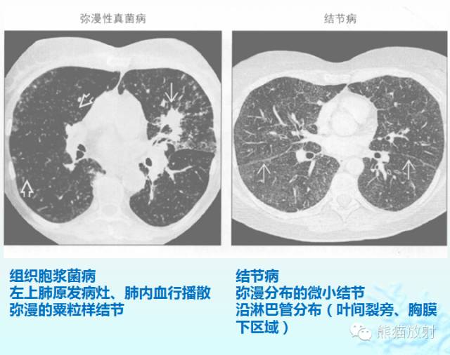 肺粟粒样结节鉴别诊断