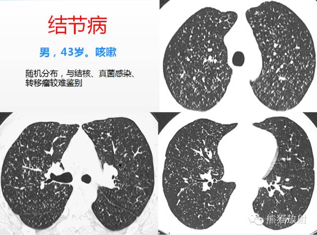 肺粟粒样结节鉴别诊断