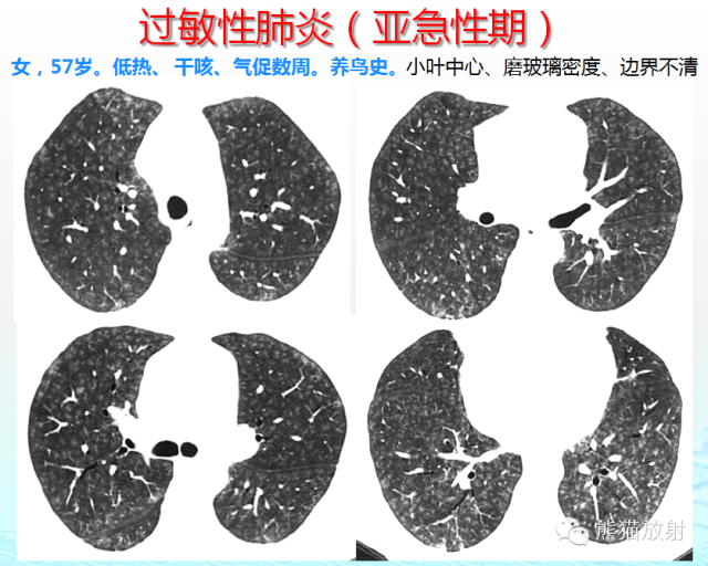 肺粟粒样结节鉴别诊断