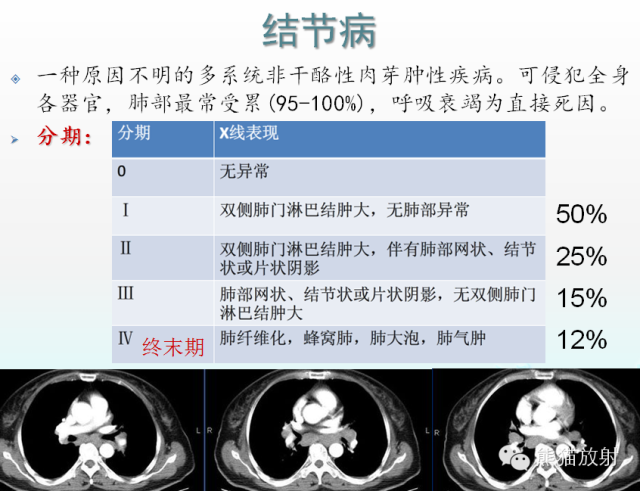 肺粟粒样结节鉴别诊断