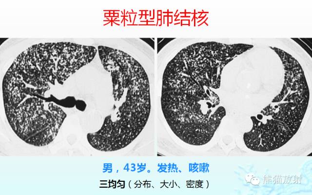 肺粟粒样结节鉴别诊断