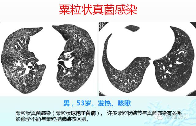 肺粟粒样结节鉴别诊断