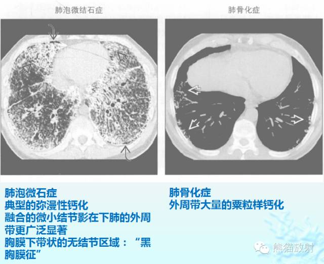 肺粟粒样结节鉴别诊断