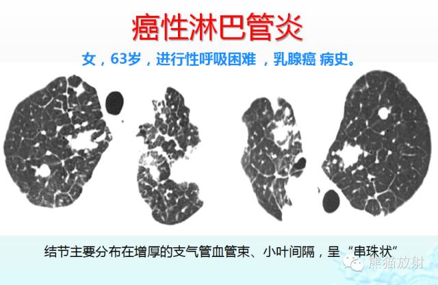 肺粟粒样结节鉴别诊断