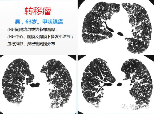 肺粟粒样结节鉴别诊断