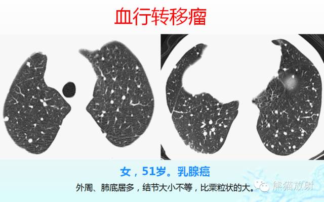 肺粟粒样结节鉴别诊断