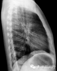 原发性肺结核的X线报告书写技巧与提示