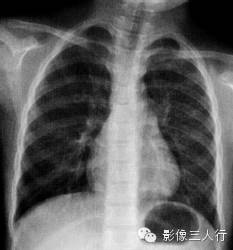 原发性肺结核的X线报告书写技巧与提示