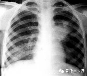 原发性肺结核的X线报告书写技巧与提示