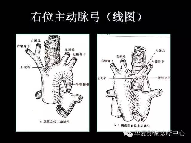 【PPT】先天性心脏病的影像学改变