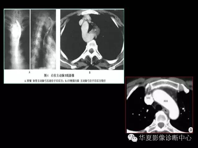 【PPT】先天性心脏病的影像学改变
