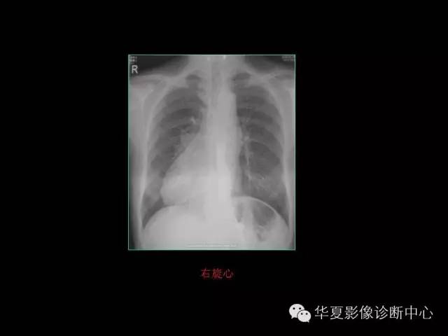 【PPT】先天性心脏病的影像学改变