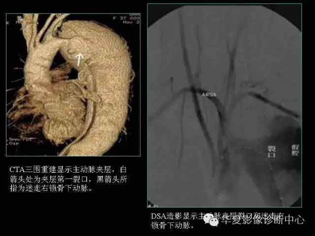 【PPT】先天性心脏病的影像学改变