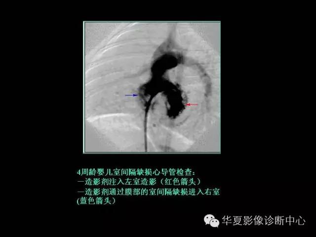 【PPT】先天性心脏病的影像学改变