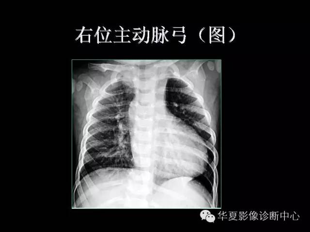 【PPT】先天性心脏病的影像学改变