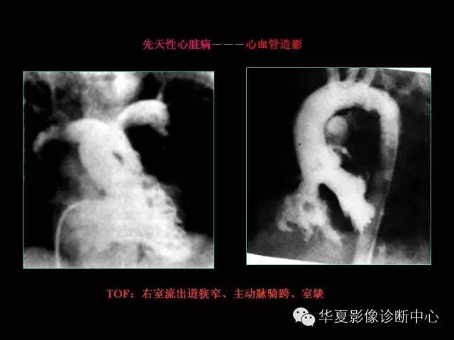 【PPT】先天性心脏病的影像学改变