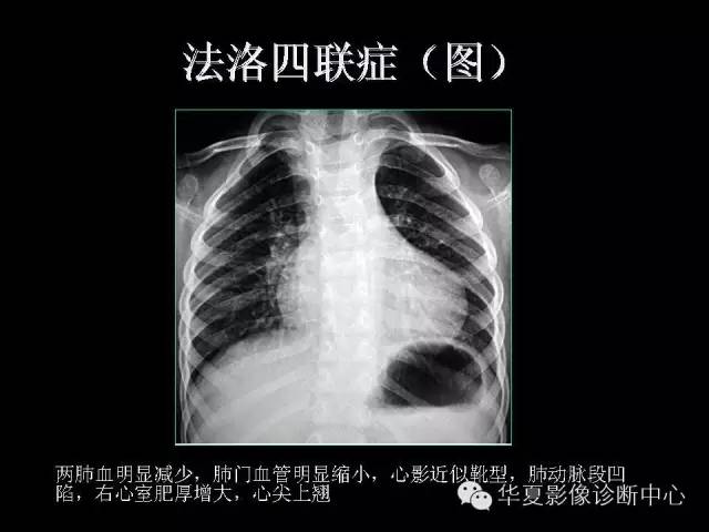 【PPT】先天性心脏病的影像学改变
