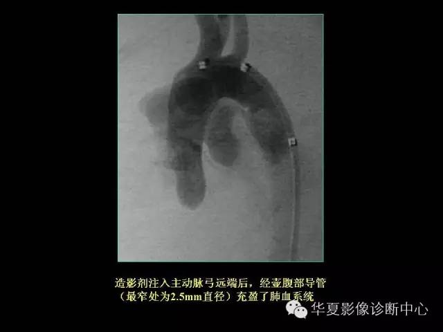 【PPT】先天性心脏病的影像学改变