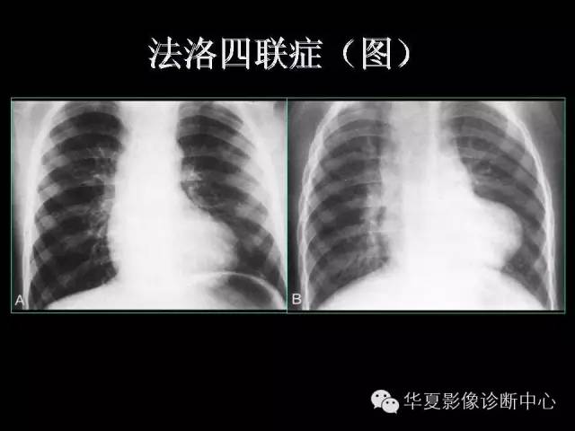 【PPT】先天性心脏病的影像学改变