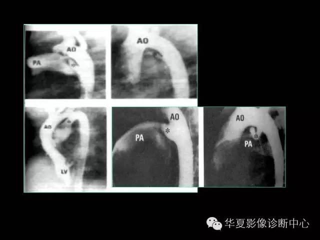 【PPT】先天性心脏病的影像学改变