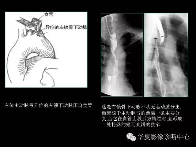 【PPT】先天性心脏病的影像学改变