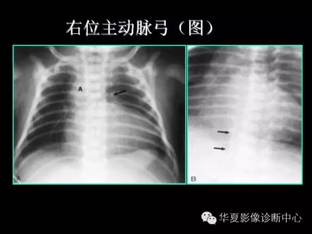 【PPT】先天性心脏病的影像学改变