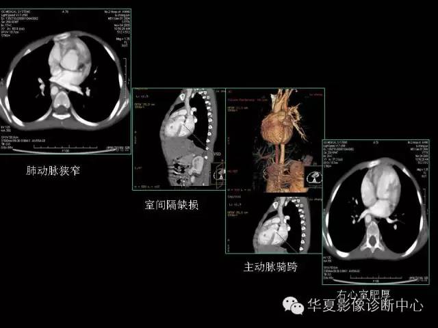 【PPT】先天性心脏病的影像学改变
