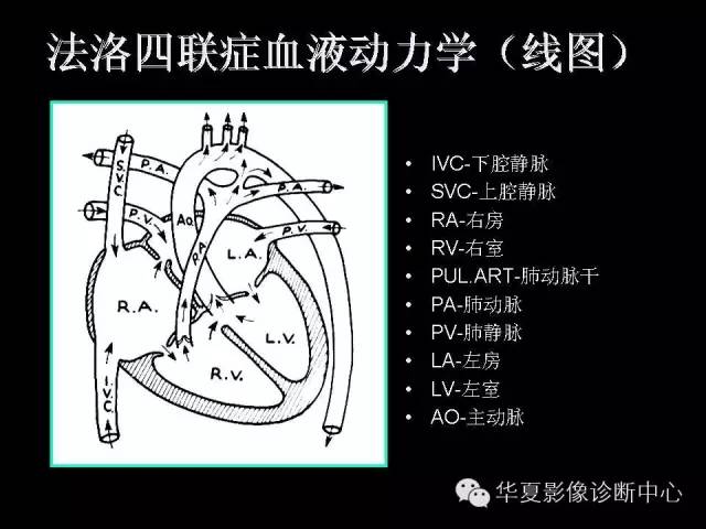 【PPT】先天性心脏病的影像学改变
