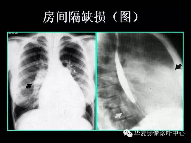 【PPT】先天性心脏病的影像学改变