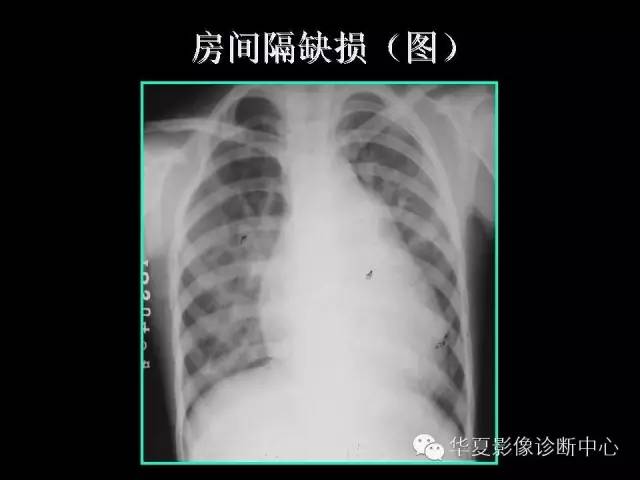 【PPT】先天性心脏病的影像学改变