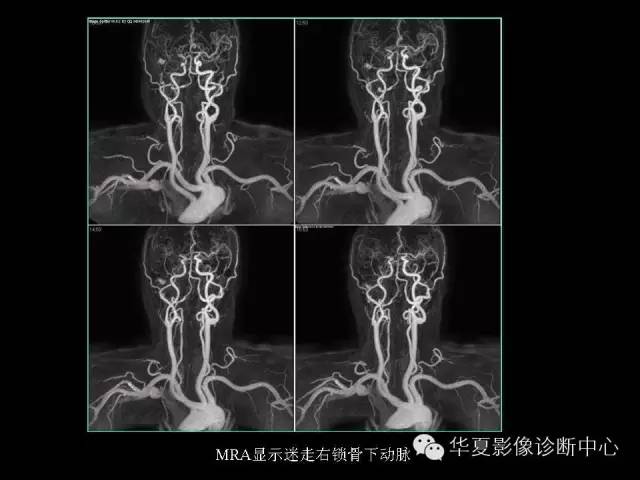 【PPT】先天性心脏病的影像学改变