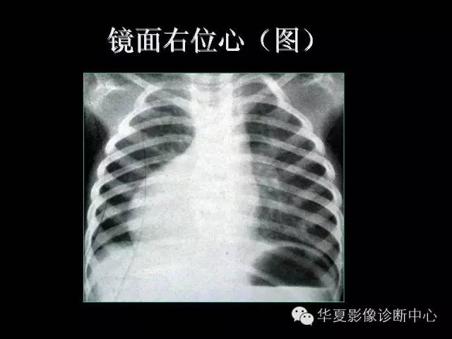 【PPT】先天性心脏病的影像学改变