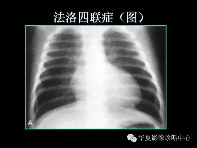 【PPT】先天性心脏病的影像学改变