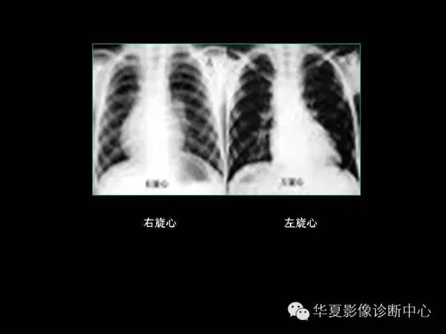 【PPT】先天性心脏病的影像学改变