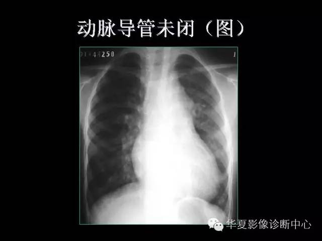 【PPT】先天性心脏病的影像学改变