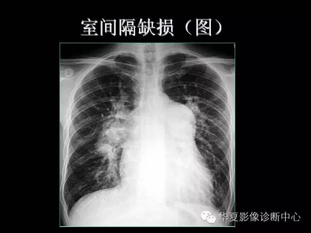 【PPT】先天性心脏病的影像学改变