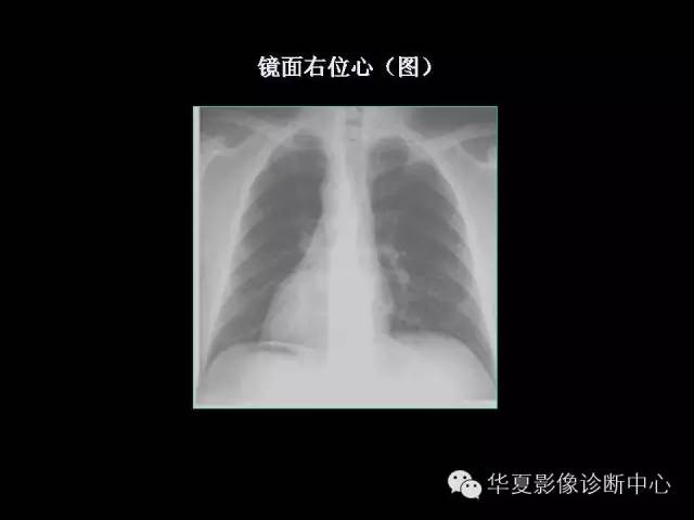 【PPT】先天性心脏病的影像学改变