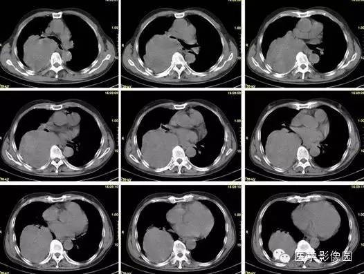 【病例】巨大中央型肺癌1例