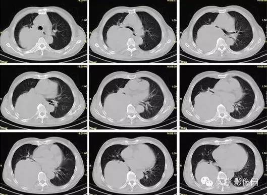 【病例】巨大中央型肺癌1例
