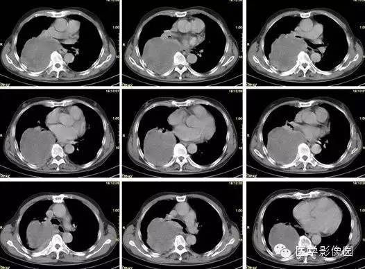 【病例】巨大中央型肺癌1例